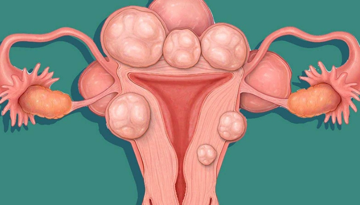 tìm hiểu chi tiết về u xơ tử cung